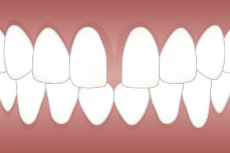 diastema
